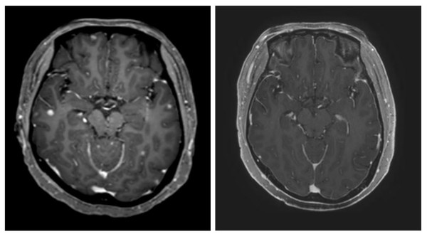 타그리소 복용 전(사진 왼쪽)과 복용 3개월 후(오른쪽) CT 사진. 하얀색이던 암 조직이 확연히 줄어들었다